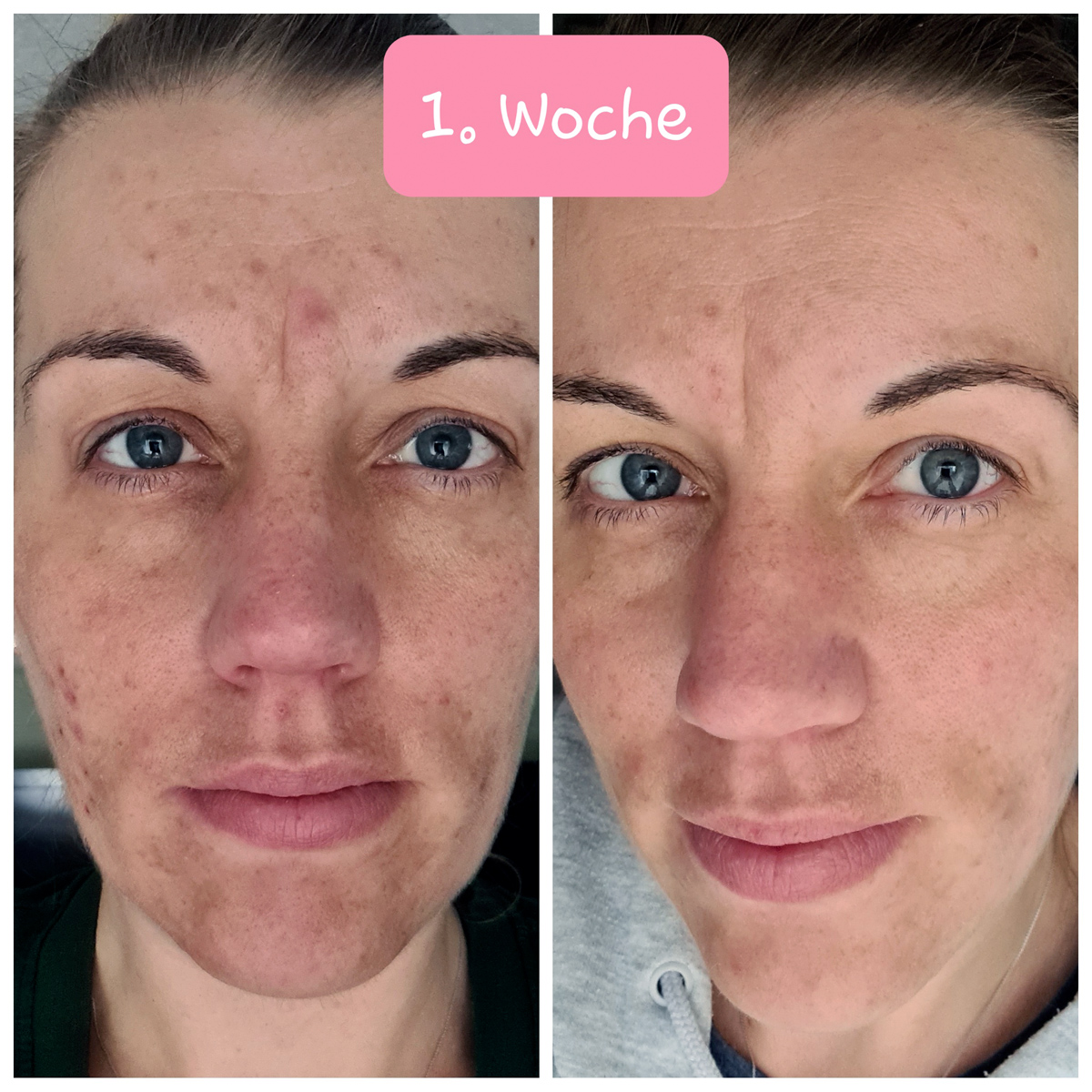 Skinlovers 4 Wochen Test